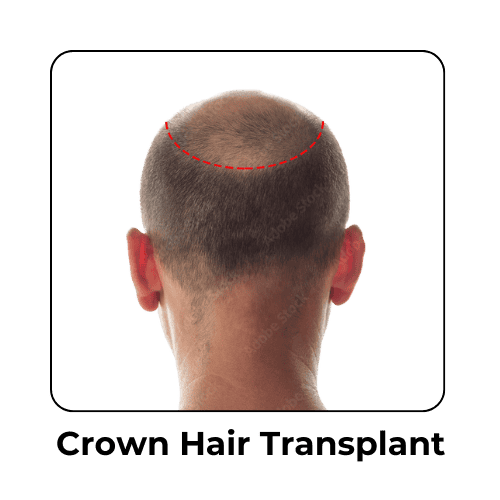 Crown Hair Transplant in Malaysia