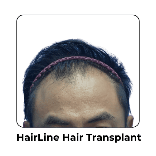 HaihairLine Hair Transplant in Malaysia