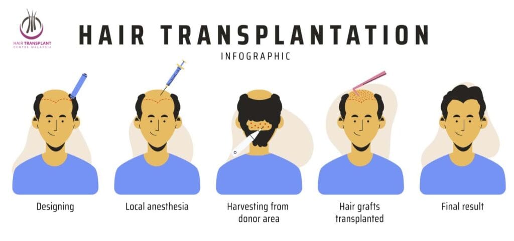 Hair Transplant Malaysia