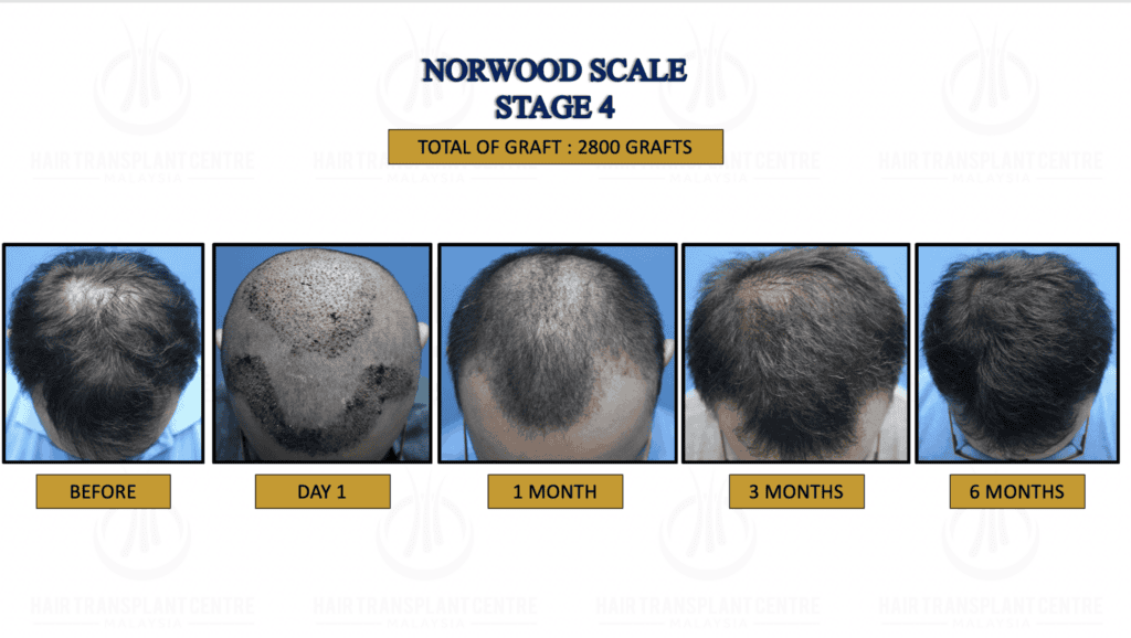 Hair Transplant Malaysia