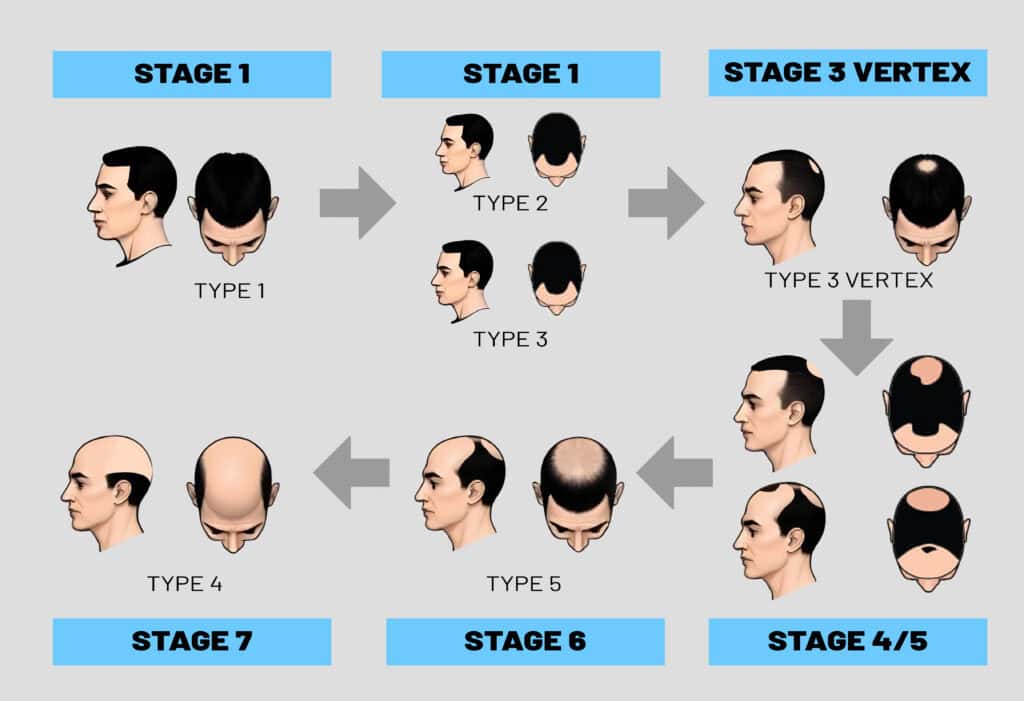 Hair Transplant Malaysian - Hair loss Steps