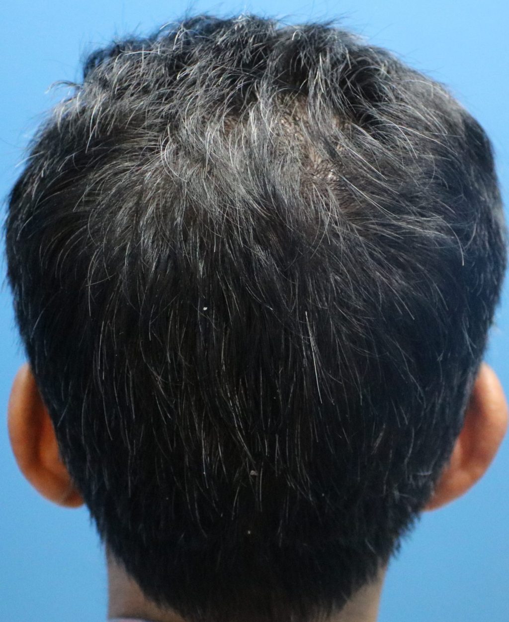 6 Months Result for Fue Male Donor Hair Transplant