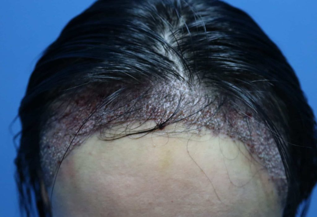 Female Lowering Hair Line