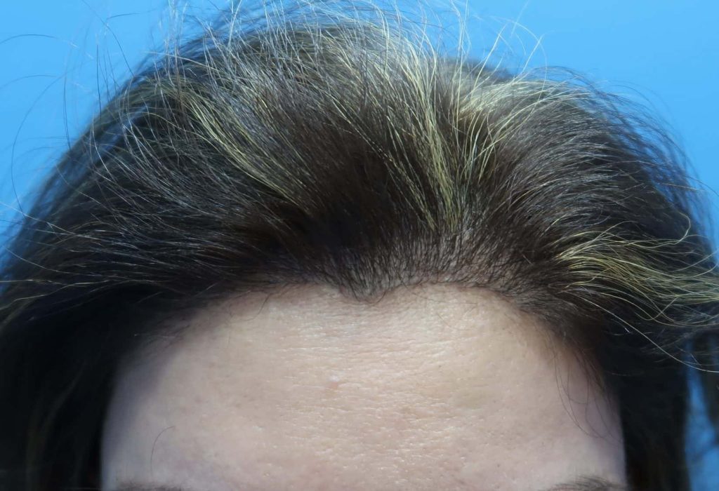 Female Hair Loss Treatment