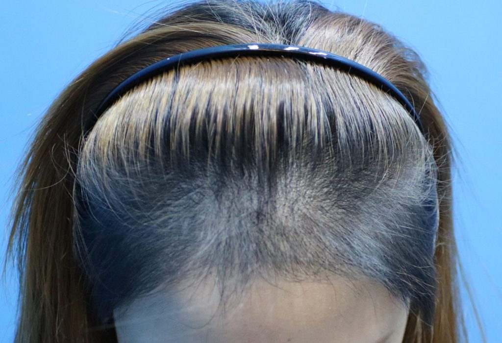 Female Hair Loss at Front angle