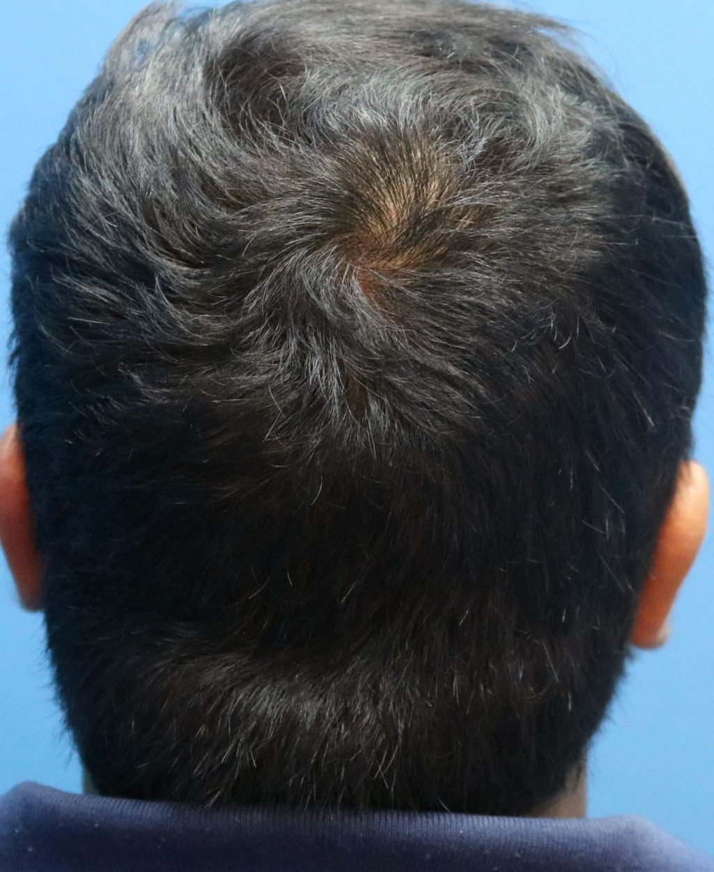 Fue Male Donor for 14 Months