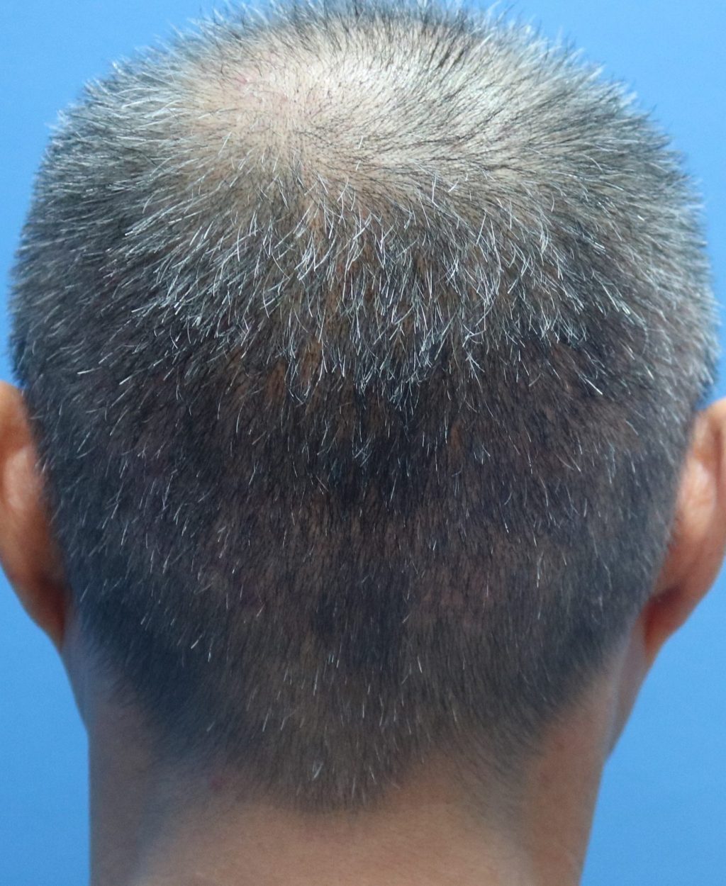Hair Transplant donor area