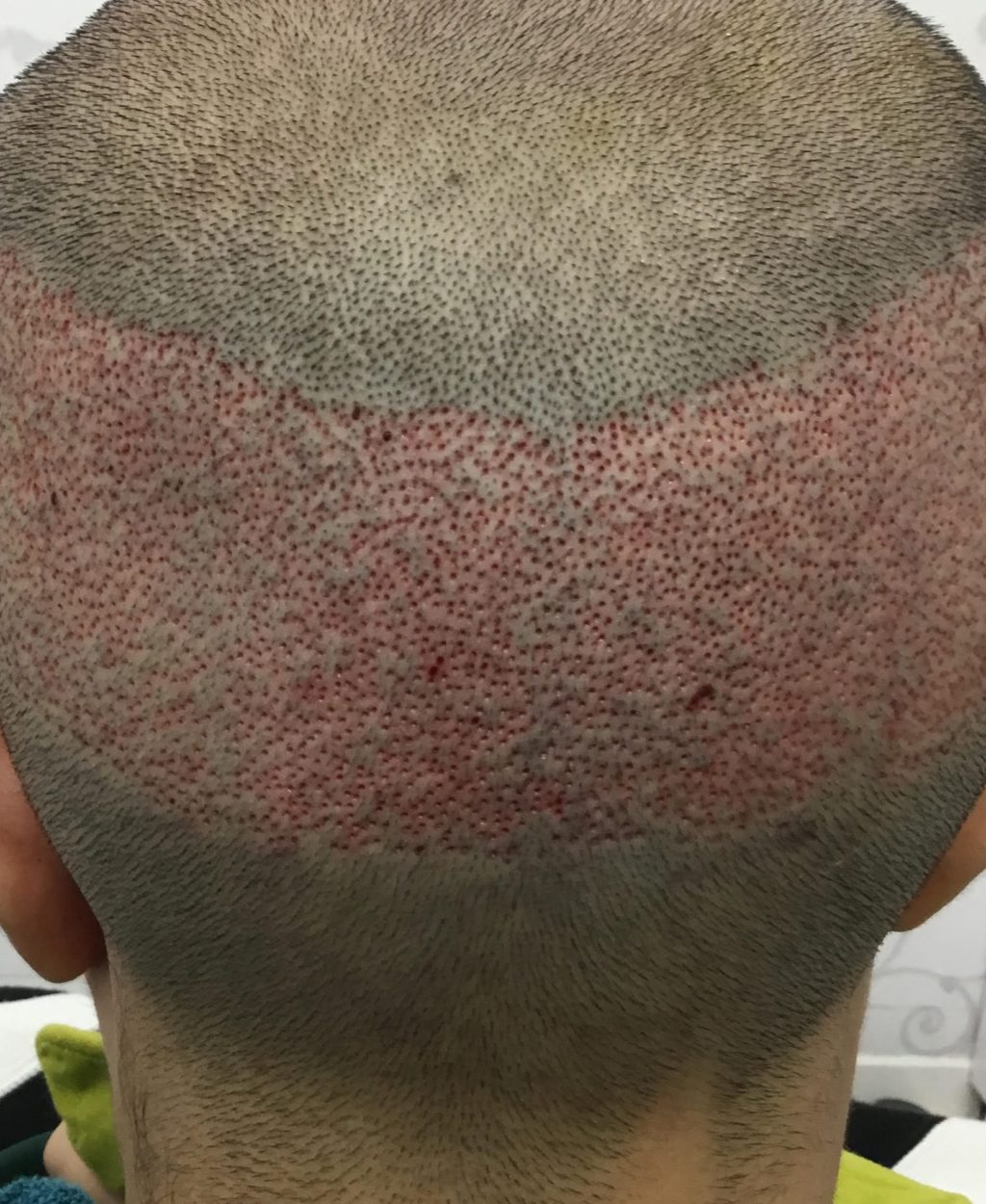 Fue Male Donor of Hair Transplant